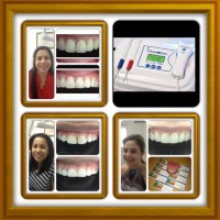 Blanqueamiento dental