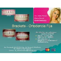 BRACKETS ORTODNCIA FIJA